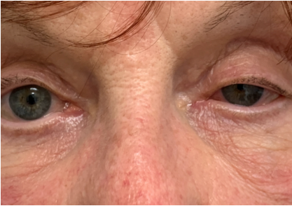 Left ptosis and miosis